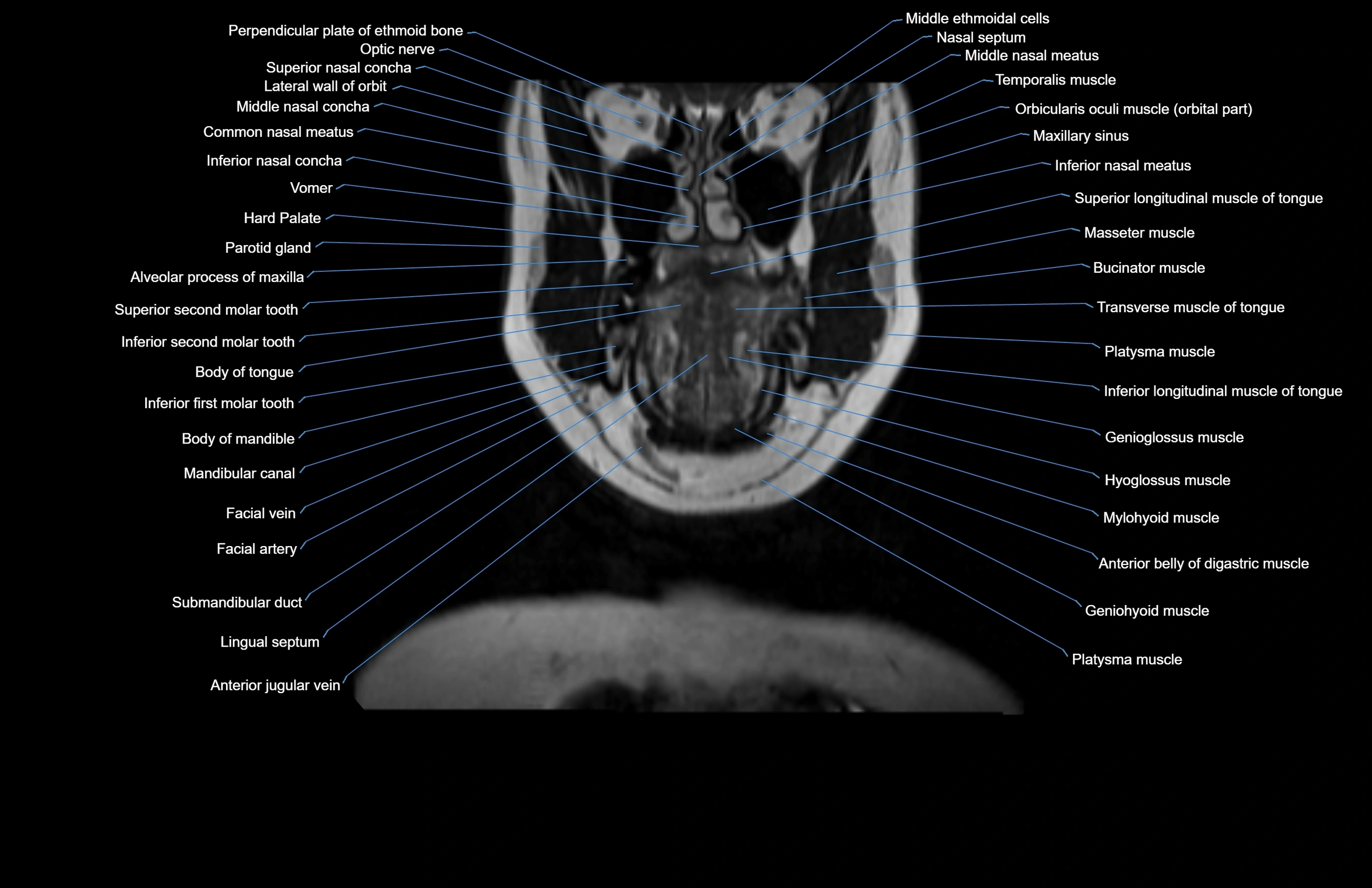 Neck coronal cross sectional MRI anatomy 3T MRI  image-img-00001-00057.webp